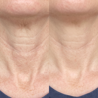 Neck before and after